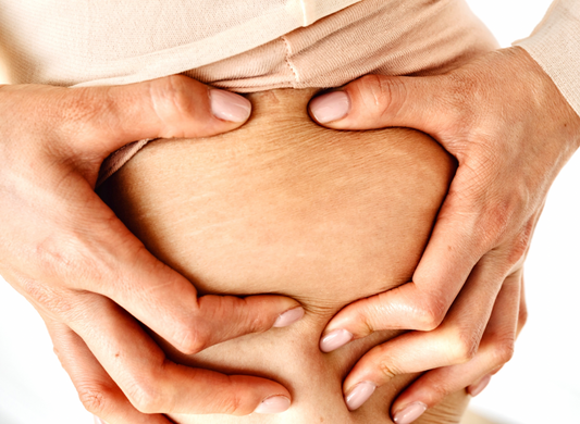 Person grabbing skin with stretch marks