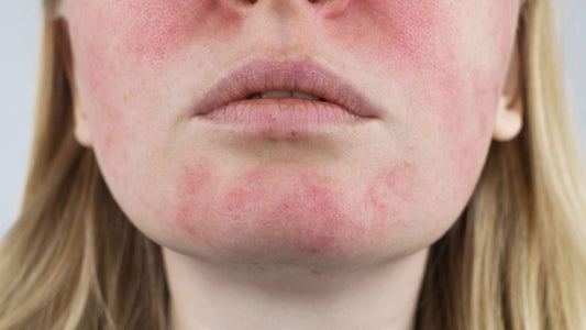 What Is Rosacea?